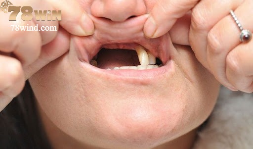 Nằm mơ thấy rụng răng mang nhiều ý nghĩa liên quan sức khoẻ